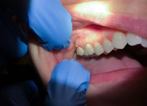 Best Emergency Dental Care for Broken or Chipped Teeth in Collinsville, MS
