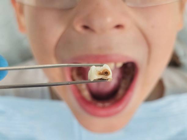 Best Emergency Wisdom Teeth Removal in Collinsville, MS