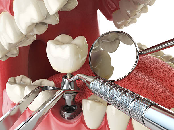 Best Urgent Care for Lost Fillings or Crowns in Collinsville, MS
